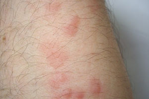 Bed Bug Bites Differ from Other Insect Bites | Bed Bug Bites on Skin
